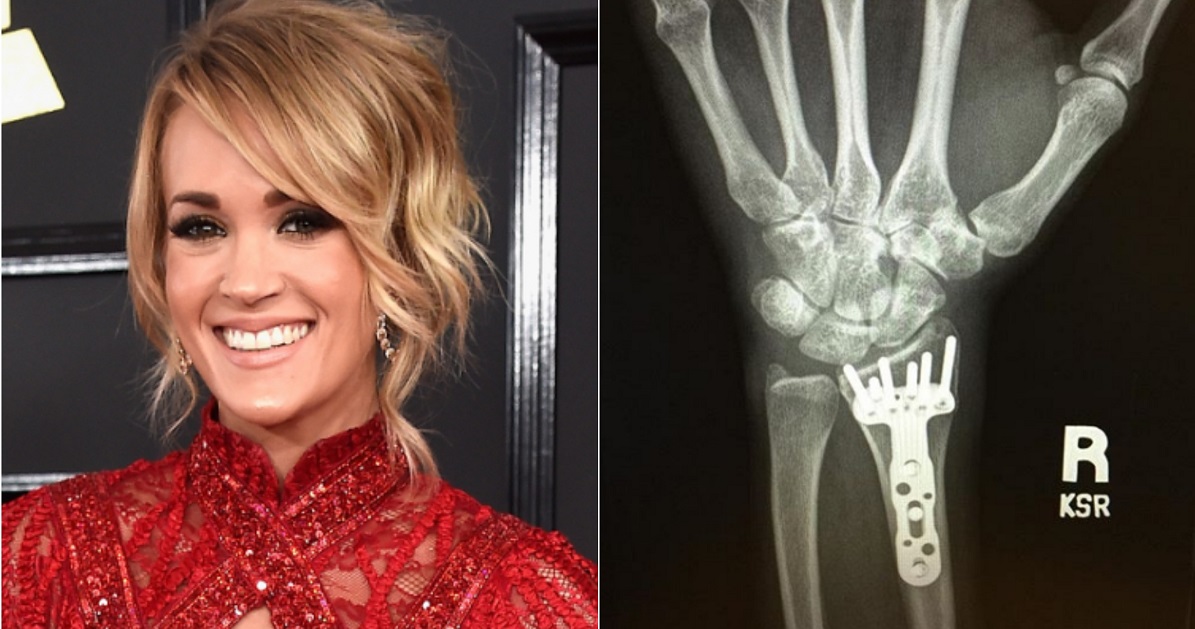 Carrie Underwood Shares an X-Ray of Her Wrist After Breaking It in a Fall